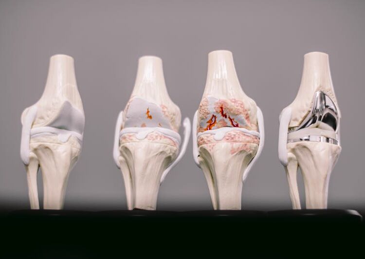 ugradnja umjetnog koljena